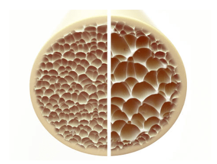 Healthy Bone and Osteoporosis Bone Comparison 3D Imaging