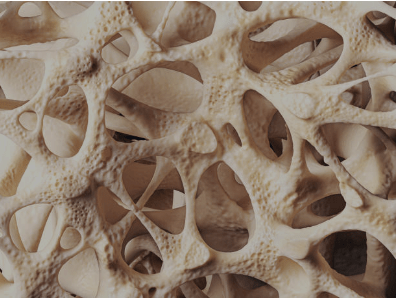 Osteoporosis Bone  3D Imaging